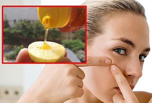 5 Tricks to get rid of blackheads