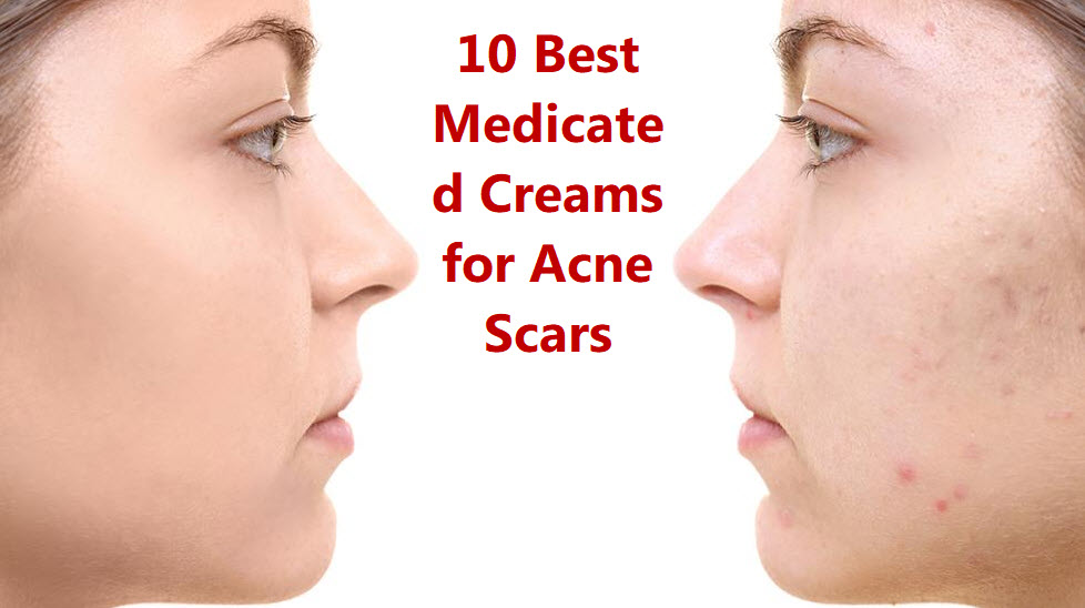 Best Medicated Creams For Acne Scars