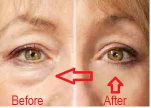 Eye Puffiness treatment
