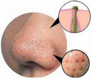 Best Product to remove blackhead
